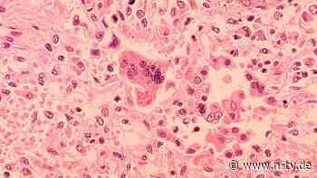 Viruserkrankung breitet sich aus: "Die Masern sind zurück" - auch in Deutschland