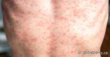 Low measles vaccine rates in parts of B.C. calls for open discussion: experts