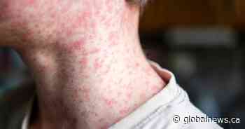 Ontario sees another sharp increase in measles cases over a week