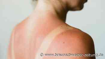 Molekularmediziner klären auf: Warum bekommen wir Sonnenbrand?