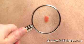 Woman diagnosed with melanoma twice like Katherine Ryan makes plea to others