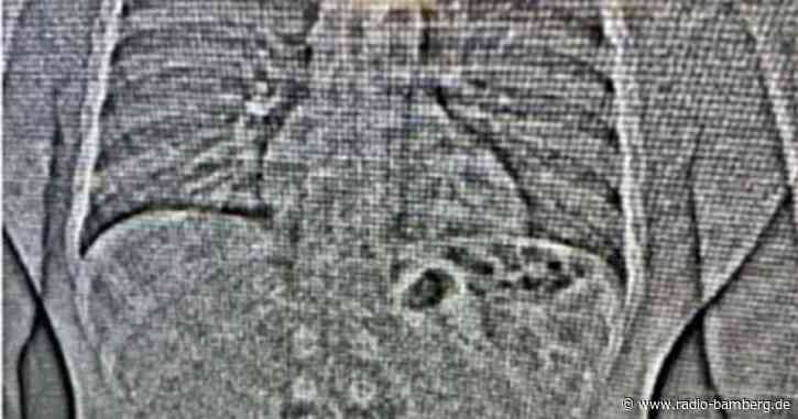 Beweisfindung per Röntgenbild: Dieb verschluckt Ohrringe