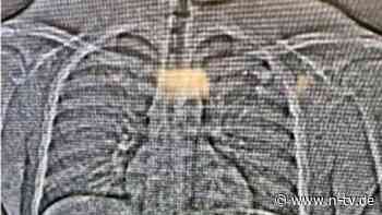 Beweisfindung per Stuhlgang: Dieb verschluckt Luxus-Ohrringe - Röntgenbild überführt ihn