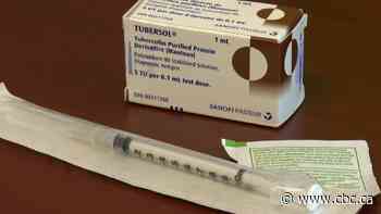 How researchers are trying to tackle Sask.'s high tuberculosis rates