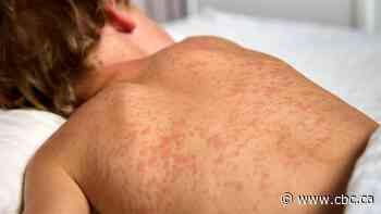 Confirmed measles case leads to exposure warnings in Saskatoon, North Battleford