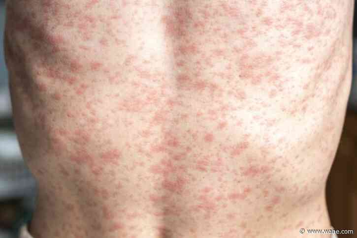 'Disappointed but not surprised': Measles cases explode in 19 states, new outbreak confirmed