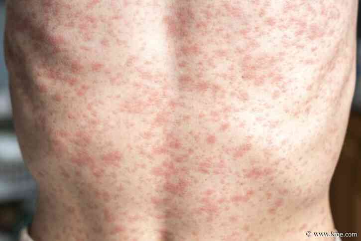 'Disappointed but not surprised': Measles cases explode in 19 states, new outbreak confirmed