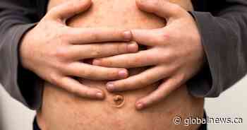 Check your measles vaccination, B.C. urges, as Ontario and Texas outbreaks grow