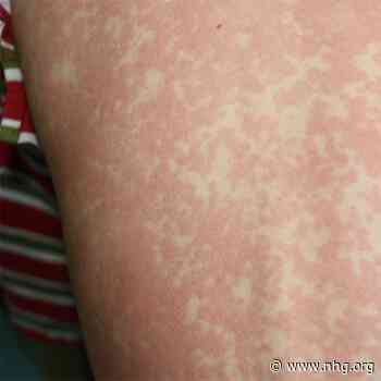 Nieuwe NHG E-learning Mazelen