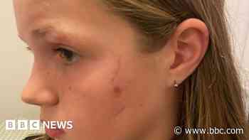 Mauled girl's dad wants compulsory dog insurance