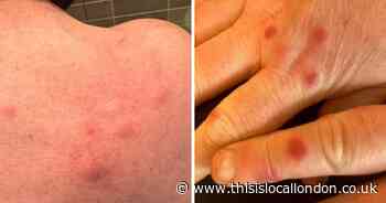 'I was bitten by bed bugs at a hotel in Stratford - now I'm being ignored'