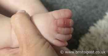 Baby nearly loses toes after strands of hair cut off circulation