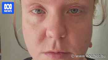 Calls for regulation as another Kmart customer experiences skin damage