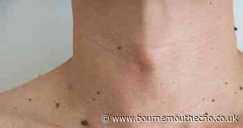 Free mole checks on offer in bid to spot skin cancer early