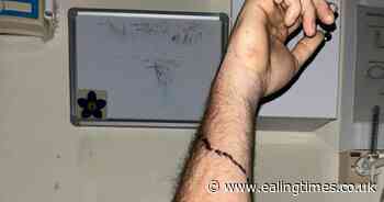 Dad issues warning over spiders in the UK - after false widow bite