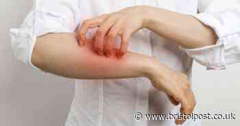 Skin condition signs 'take eight weeks to appear' - when to see GP