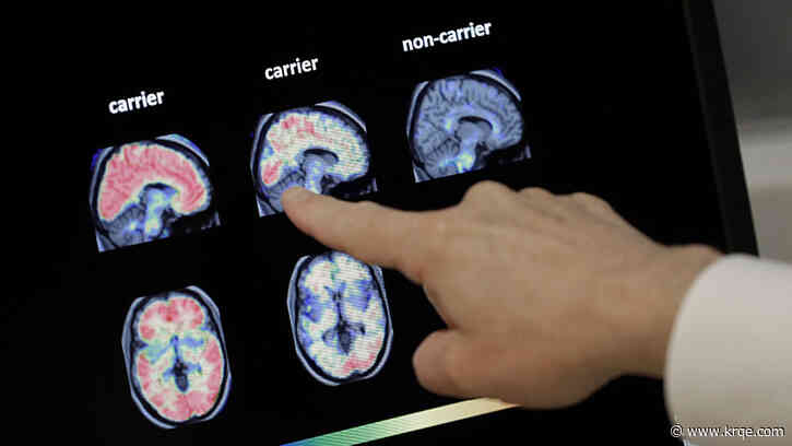 Here's another reason to get the shingles vaccine: It may fight dementia