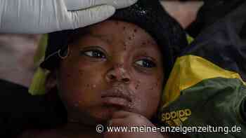 Experten-Warnung: Mpox könnte zu ernster Bedrohung werden