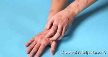 UKHSA investigation after patient found to have Clade Ib mpox with no links to confirmed cases