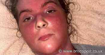 'I would give anything to have eczema again rather than this'
