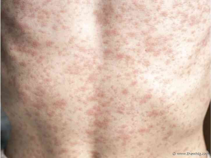 Second case of measles confirmed in Kingston, public health warns of exposures