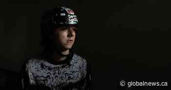 Edmonton teen attacked in Dominican Republic to have missing piece of skull replaced