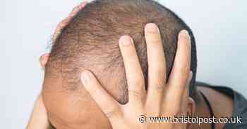 Widespread habit followed by 5.6 million Brits linked to hair loss