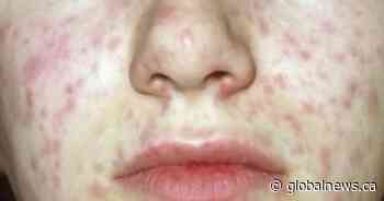 Alberta reports 16 more cases of measles, bringing total to 74