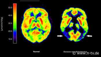 Antikörper Lecanemab: EU-Kommission lässt Wirkstoff gegen Alzheimer zu