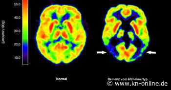 Alzheimer-Therapie: EU-Kommission lässt Wirkstoff Lecanemab zu