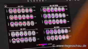 EU-Kommission lässt neuartigen Alzheimer-Wirkstoff Lecanemab zu
