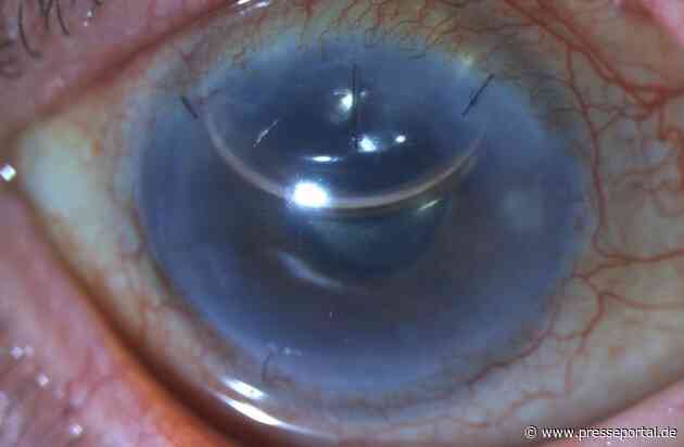 Neue Hoffnung für Patient:innen mit Hornhauterkrankungen: Erste Implantation einer künstlichen Hornhautschicht in Norddeutschland