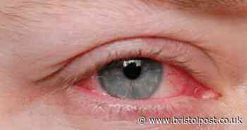 Eye symptom could mean you're at risk of high cholesterol