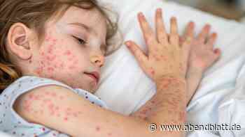 Windpocken-Ausbruch: Hamburger Schule zählt schon 23 Fälle