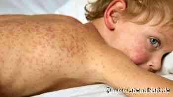 Windpocken an Waldorfschule ausgebrochen – schon mehr als 20 Fälle