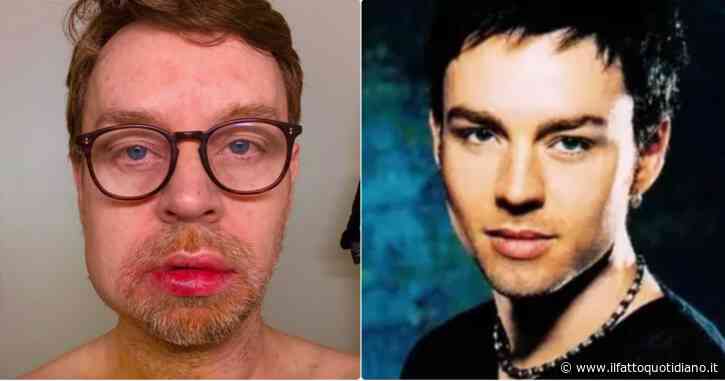 “La mascella si è spezzata a metà, mi sono svegliato in una pozza di sangue”: Darren Hayes dei Savage Garden irriconoscibile dopo l’incidente