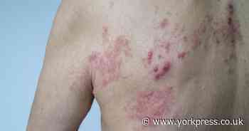 What is shingles? Major questions answered from its cause to if it can kill you