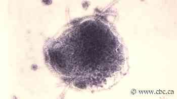 Quebec says measles outbreak has ended