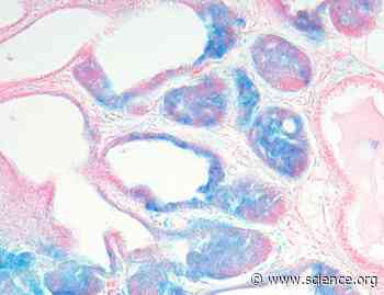 Re-epithelialization of cancer cells increases autophagy and DNA damage: Implications for breast cancer dormancy and relapse | Science Signaling
