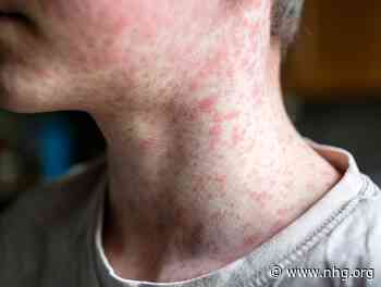 Kans op mazelen blijft aanwezig