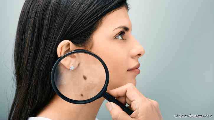 Blood test could predict skin cancer recurrence, study shows