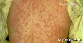 Measles advisory issued for Taber Health Centre