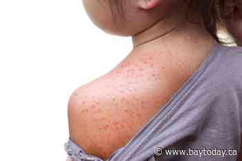 Potential measles exposure linked to Ontario Northland bus trips