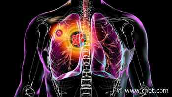 Tuberculosis: What You Need to Know About the Recent Outbreak, Risk Factors, Symptoms and Treatment