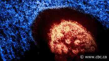 New measles case confirmed in B.C.'s Lower Mainland