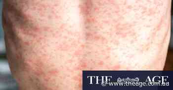‘A catastrophe of a disease’: Doctors sound alarm on spread of measles