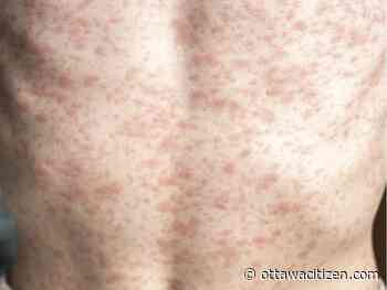 Potential measles exposures in Renfrew, Outaouais and Ottawa
