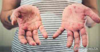 Alberta reports 17 more cases of measles, bringing total to more than 200