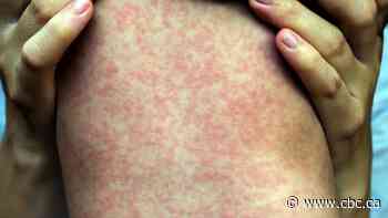 Province warns of possible measles exposure at Gretna Elementary School, 3 Winkler locations