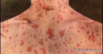 Alberta ramps up measles vaccination campaign as 3 hospitalized in intensive care